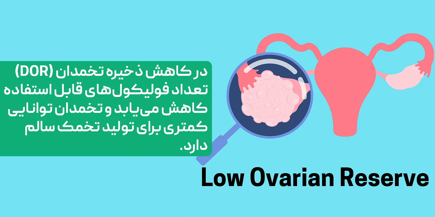  کاهش ذخیره تخمدان (DOR)