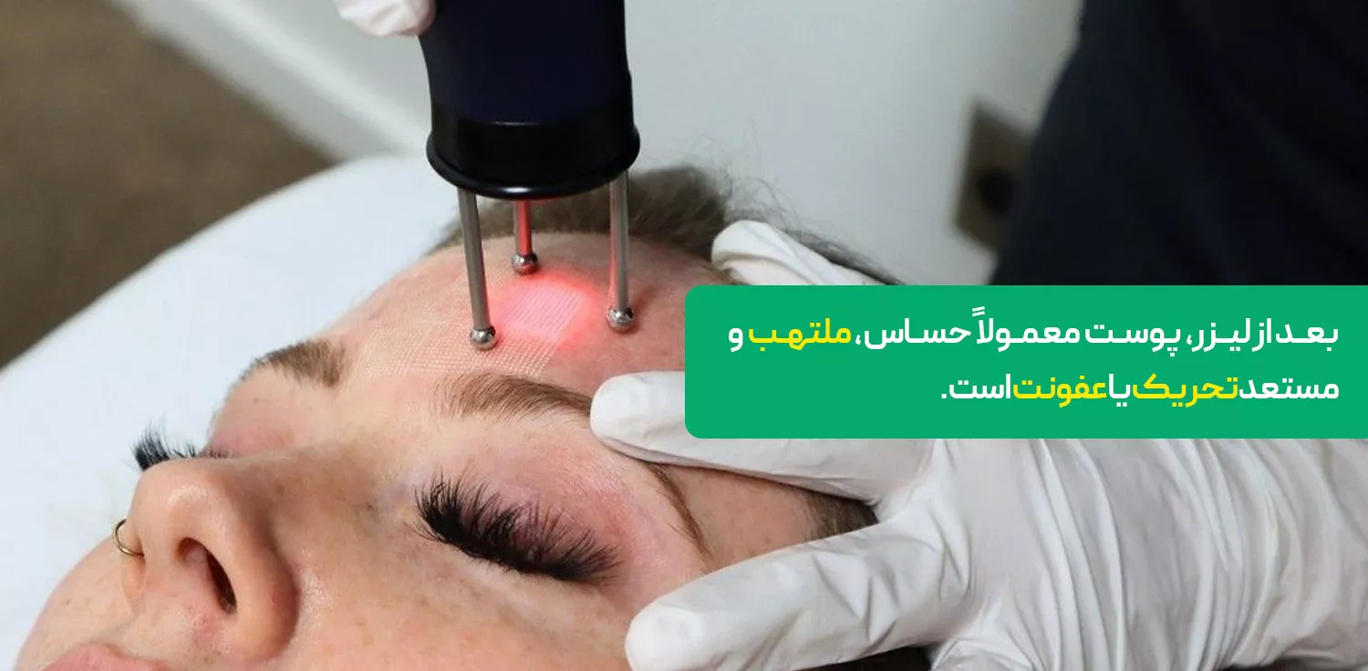 استفاده از پماد زینک اکساید بعد از لیزر