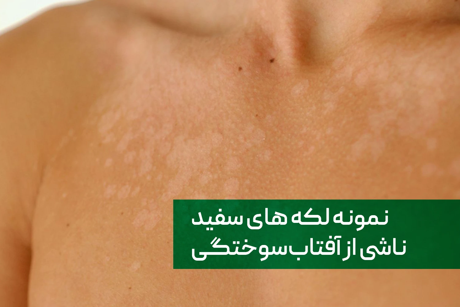 لکه های سفید پوستی ناشی از آفتاب سوختگی | داروخانه آنلاین ژن سبز