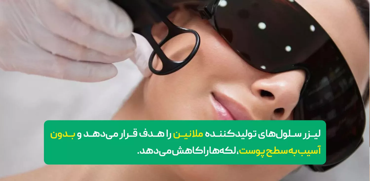 لیزر درمانی لکه های صورت