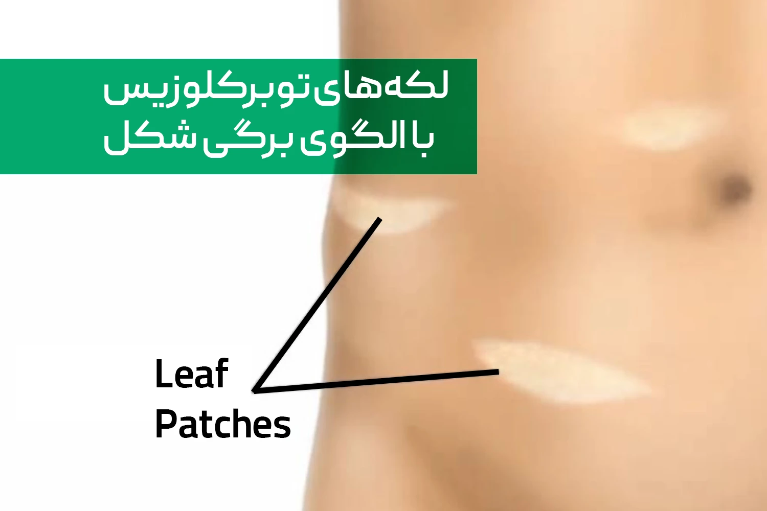لکه های سفید برگی شکل جذام | داروخانه آنلاین ژن سبز