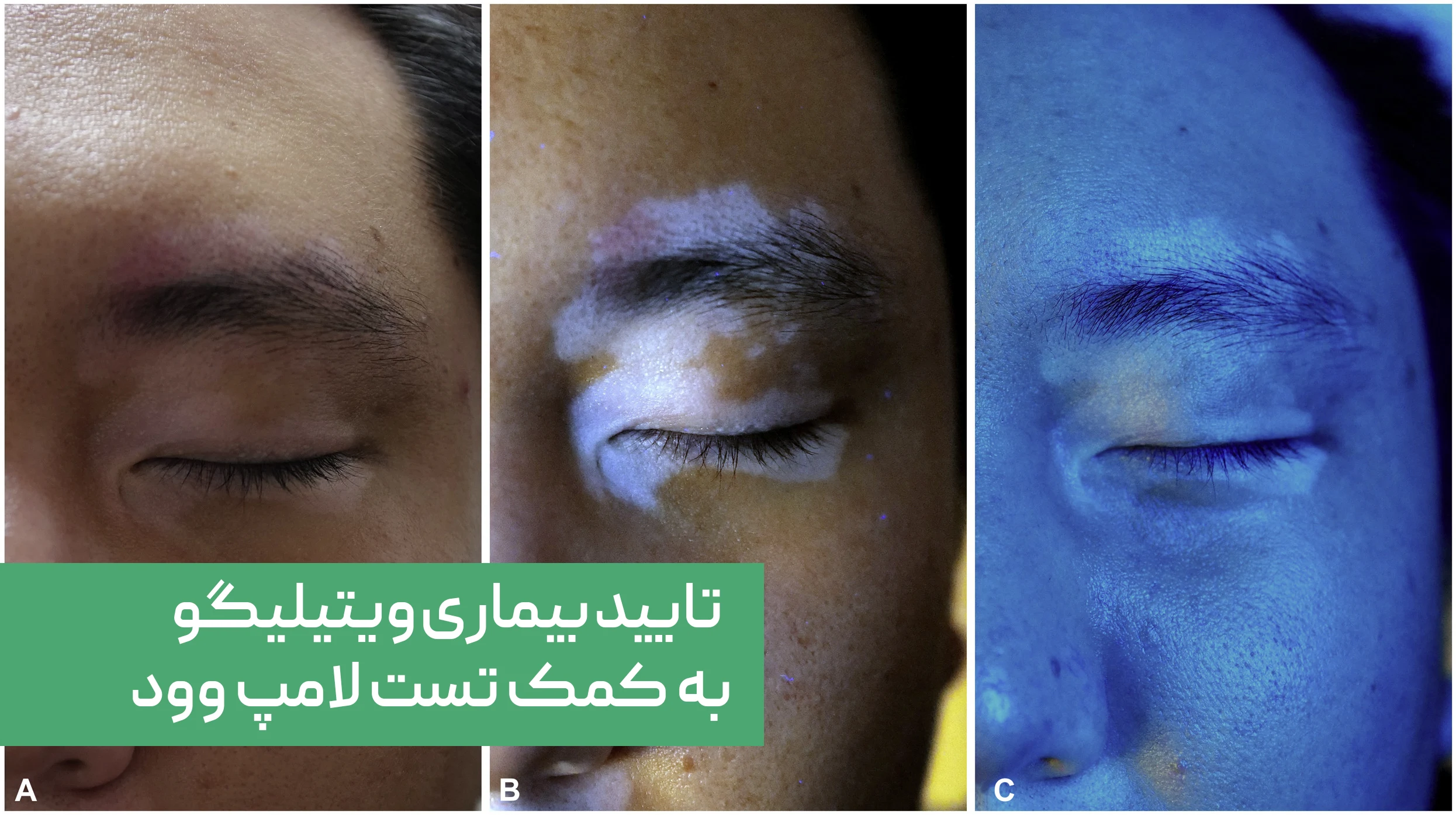 لکه های سفید ویتیلیگو در تست لامپ وود | داروخانه آنلاین ژن سبز