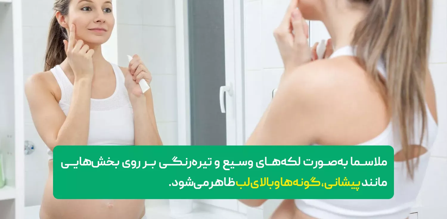 لک‌های ملاسما (لک‌های بارداری)