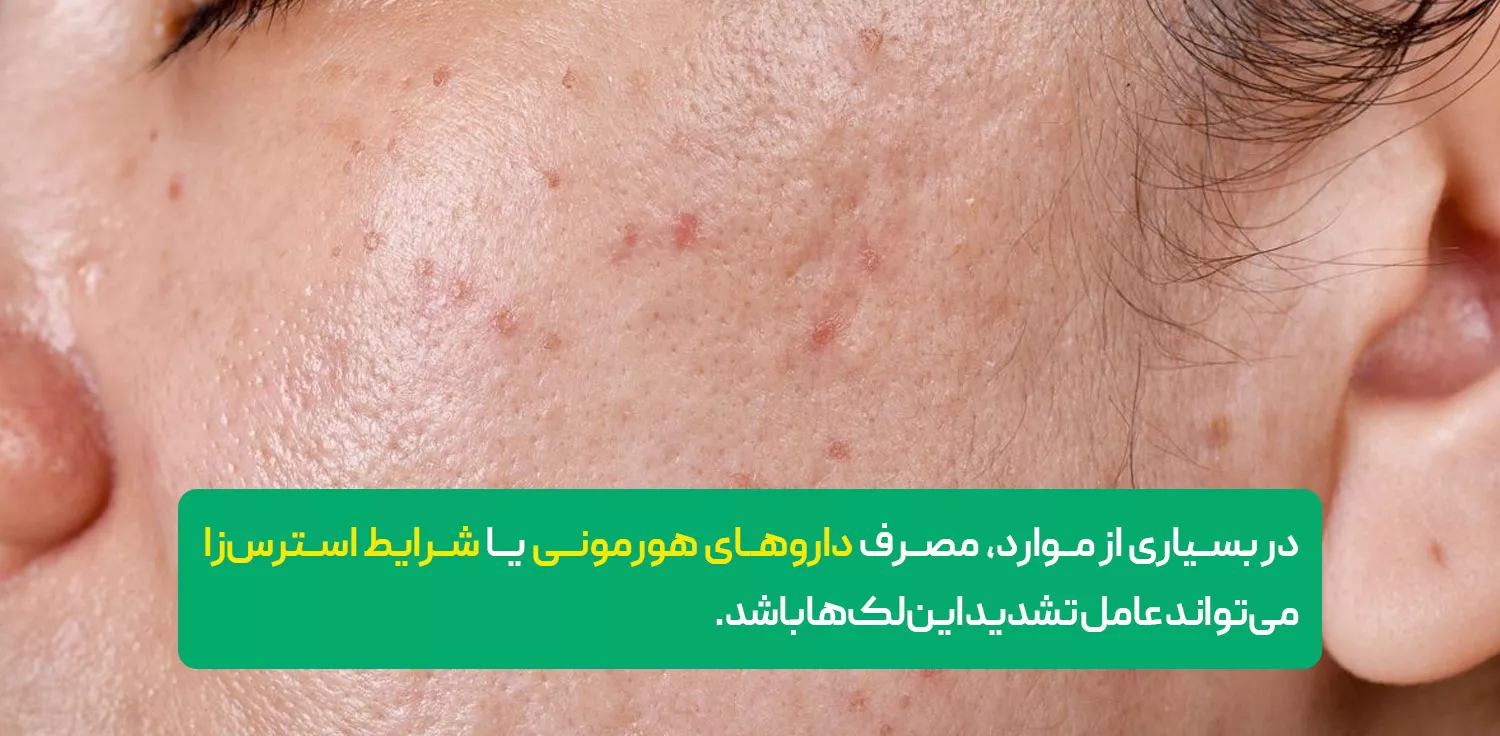 لک‌های هورمونی (لک‌های اضطرابی)