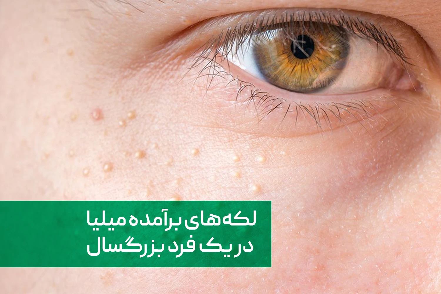 لکه های سفید میلیا روی پوست | داروخانه آنلاین ژن سبز