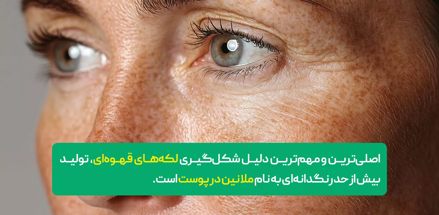  برخی دلایل ایجاد لک قهوه ای روی صورت