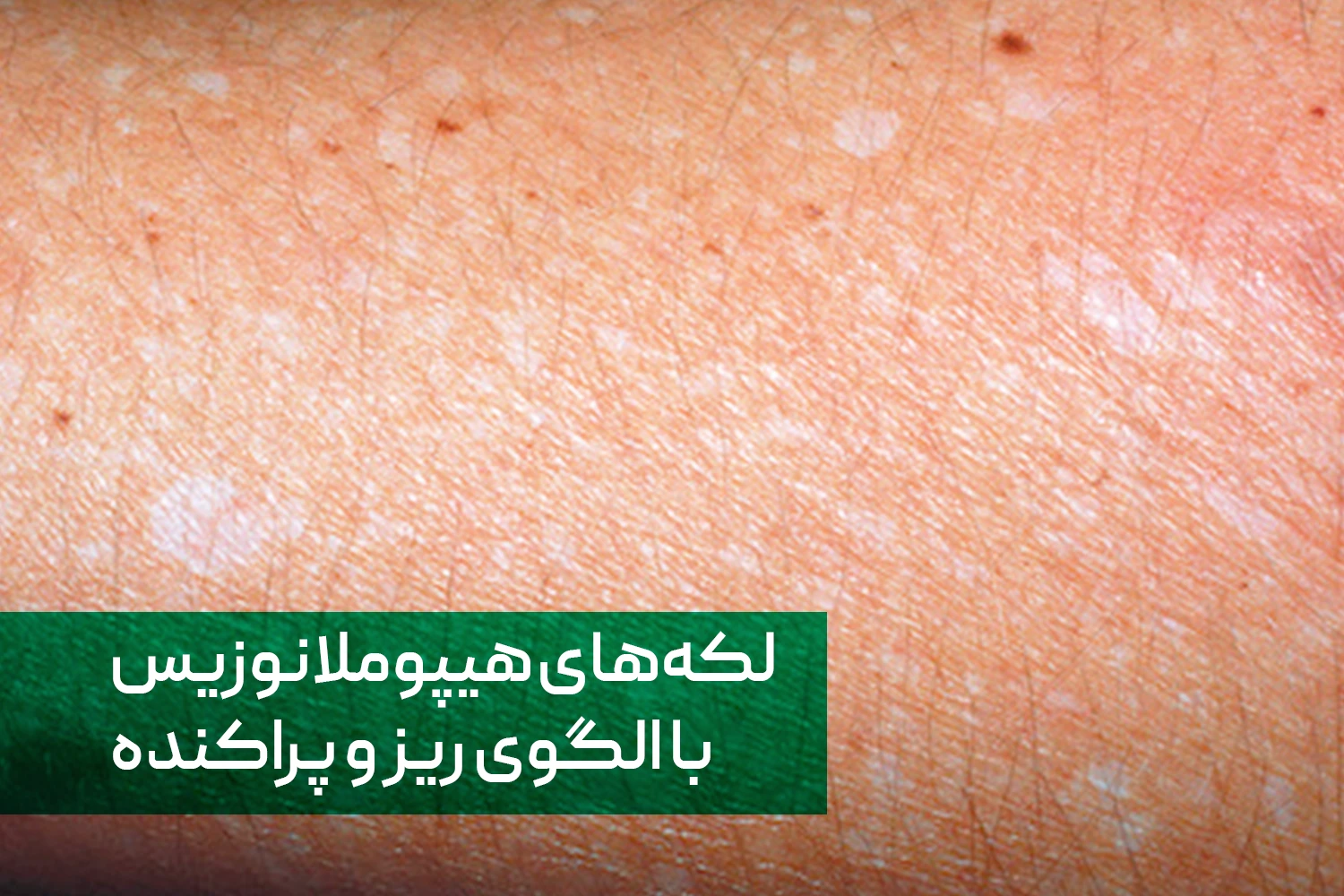 Idiopathic Guttate Hypomelanosis | داروخانه آنلاین ژن سبز
