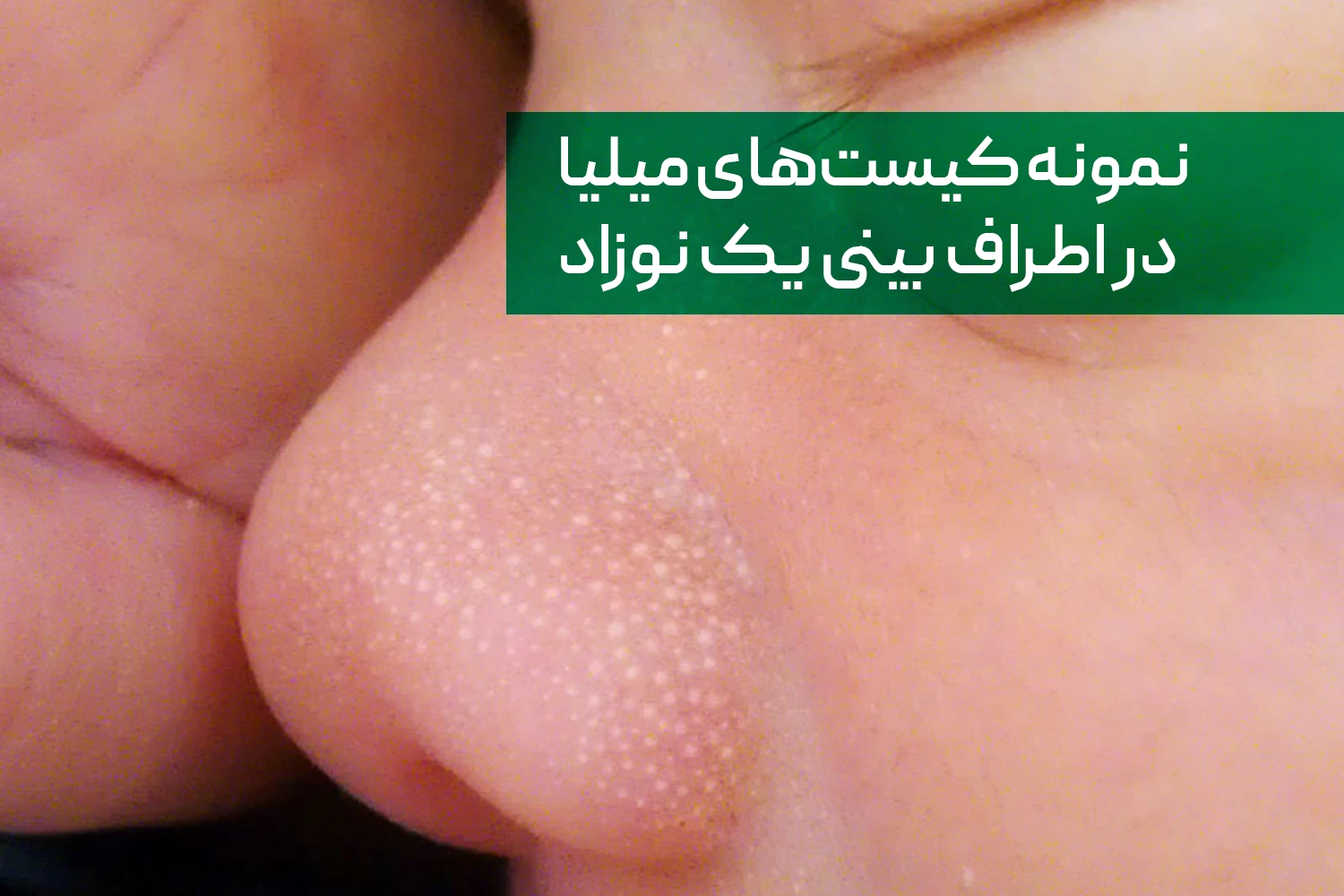 نمونه کیست های میلیا در یک نوزاد | داروخانه آنلاین ژن سبز