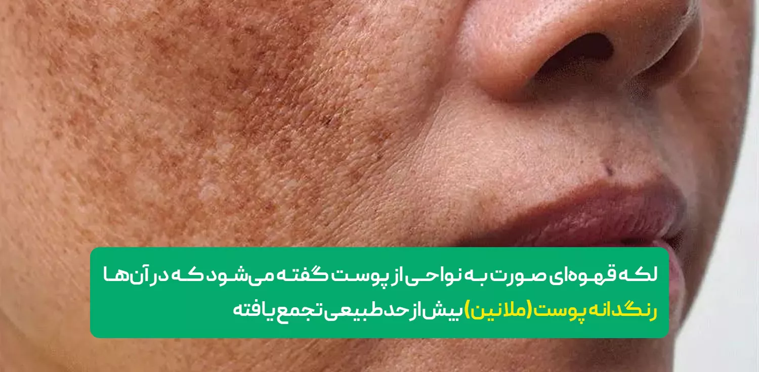 لک قهوه ای صورت چیست؟