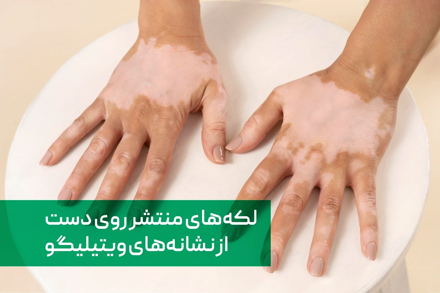 لکه های سفید روی پوست ویتیلیگو | داروخانه آنلاین ژن سبز