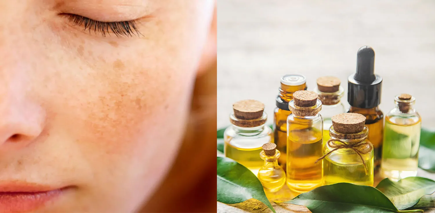 بهترین روغن برای درمان لک بارداری