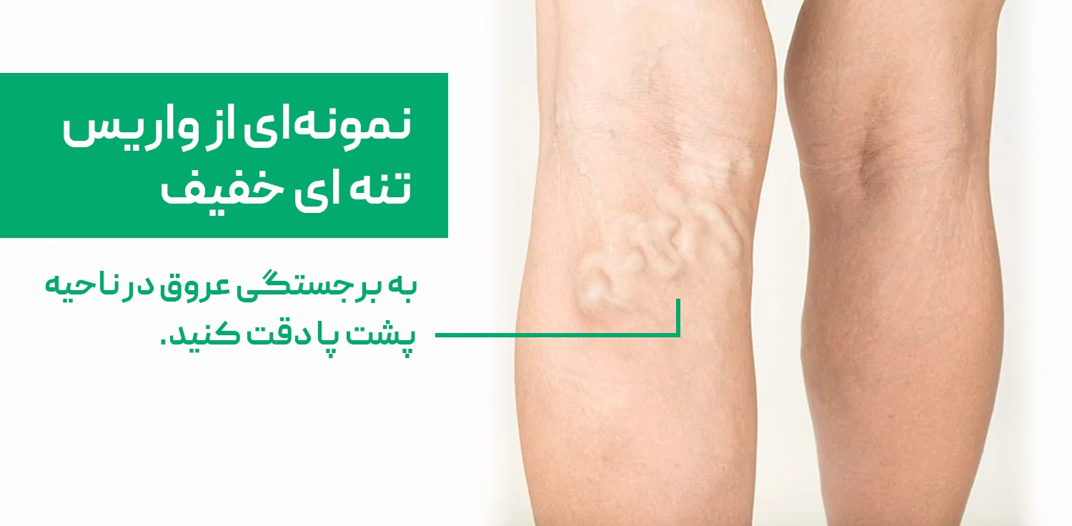 نمونه از واریس تنه ای خفیف در پشت پا