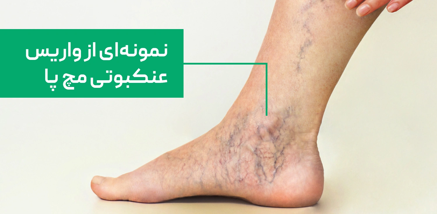 نمونه ای از واریس عنکبوتی در مچ پا