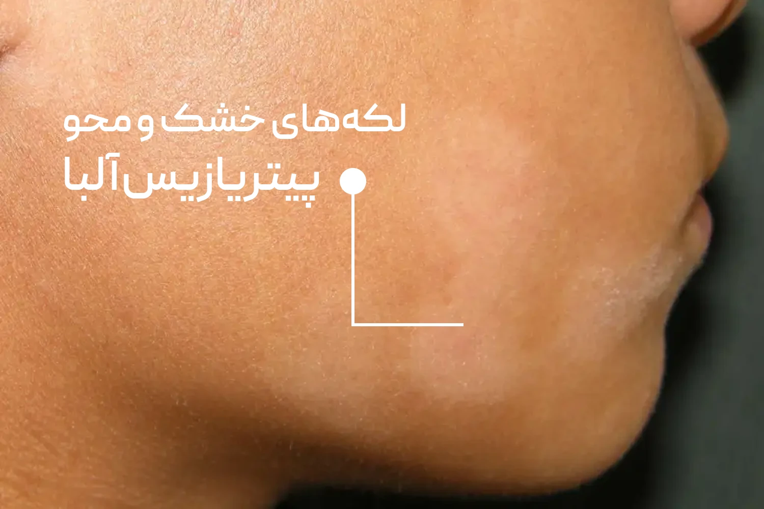 لکه های سفید پیتریازیس آلبا | داروخانه آنلاین ژن سبز