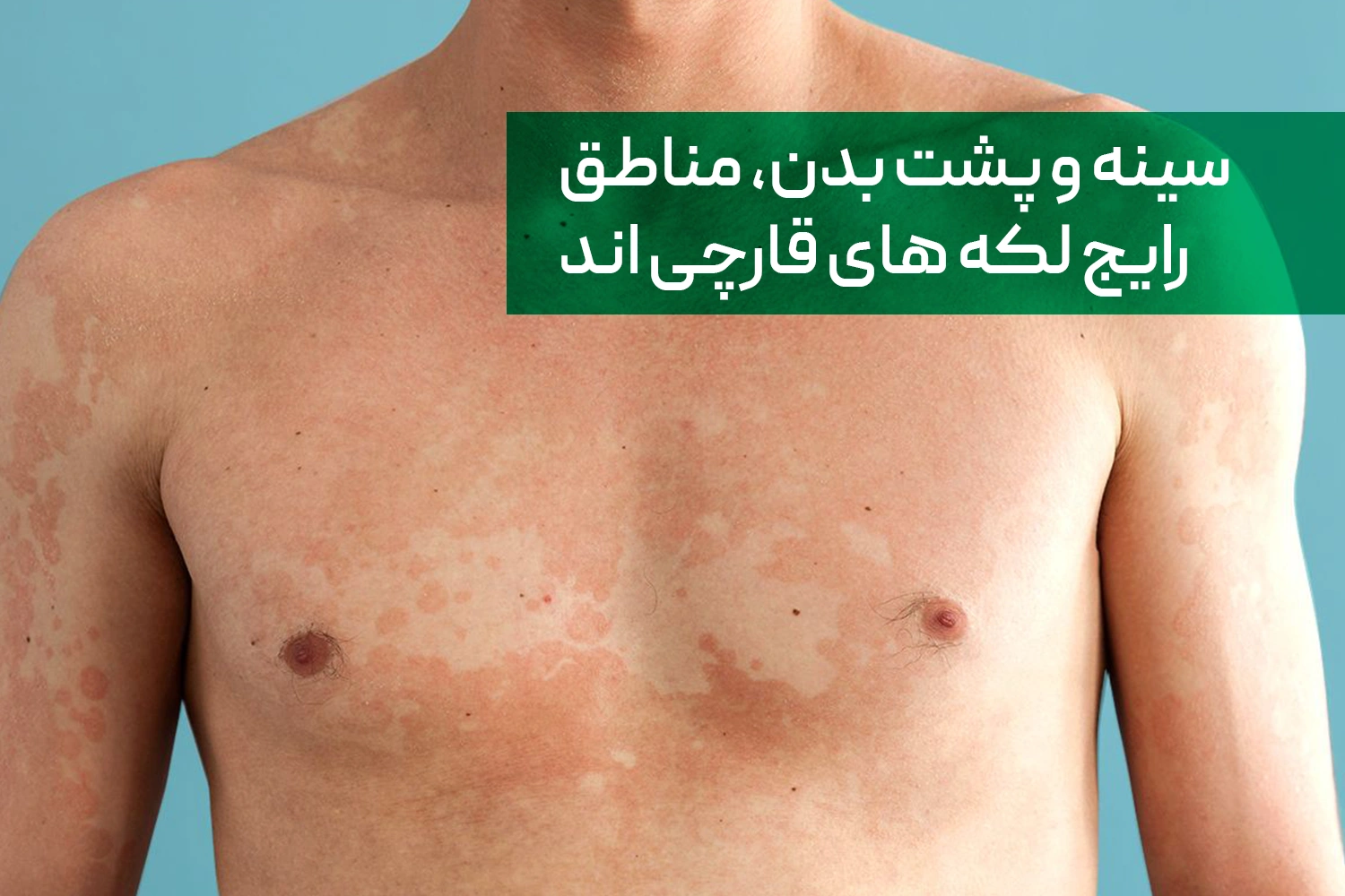لکه های سفید تینه‌آ ورسیکالر | داروخانه آنلاین ژن سبز