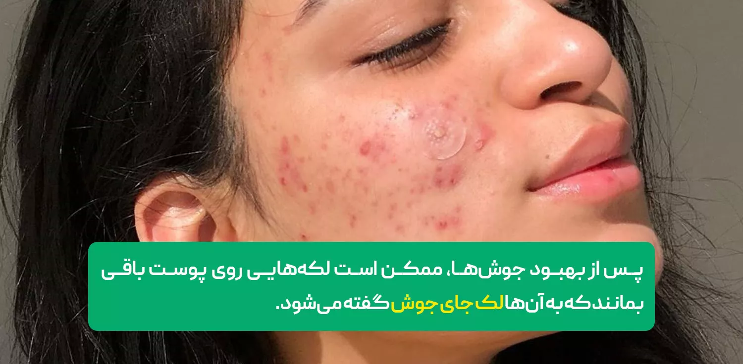 لک‌های جای جوش (آکنه اسکار)