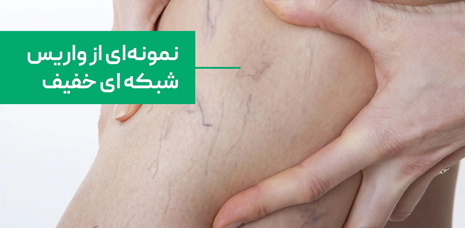 نمونه ای از واریس شبکه ای خفیف در پشت پا
