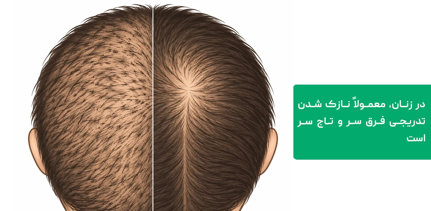 دو الگوی ریزش مو در زنان؛ ریزش پخشی و نازک شدن فرق سر و تاج
