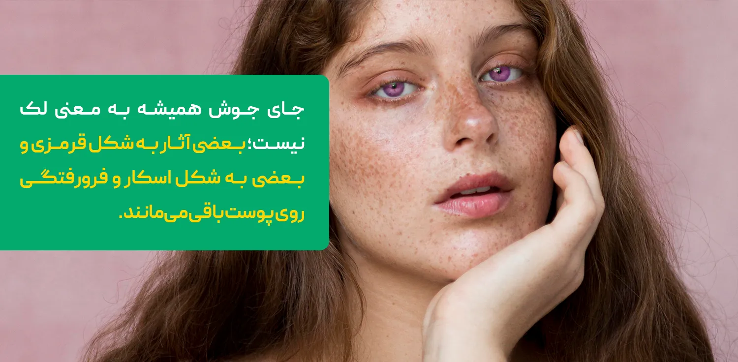 لک قهوه&zwnj;ای روی پوست