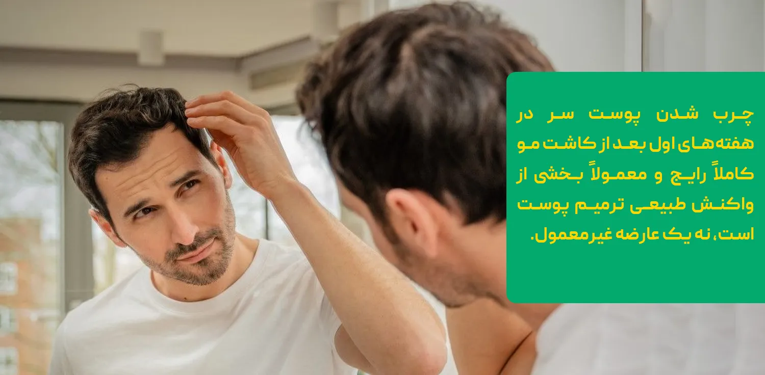 درمان قطعی چربی موی سر
