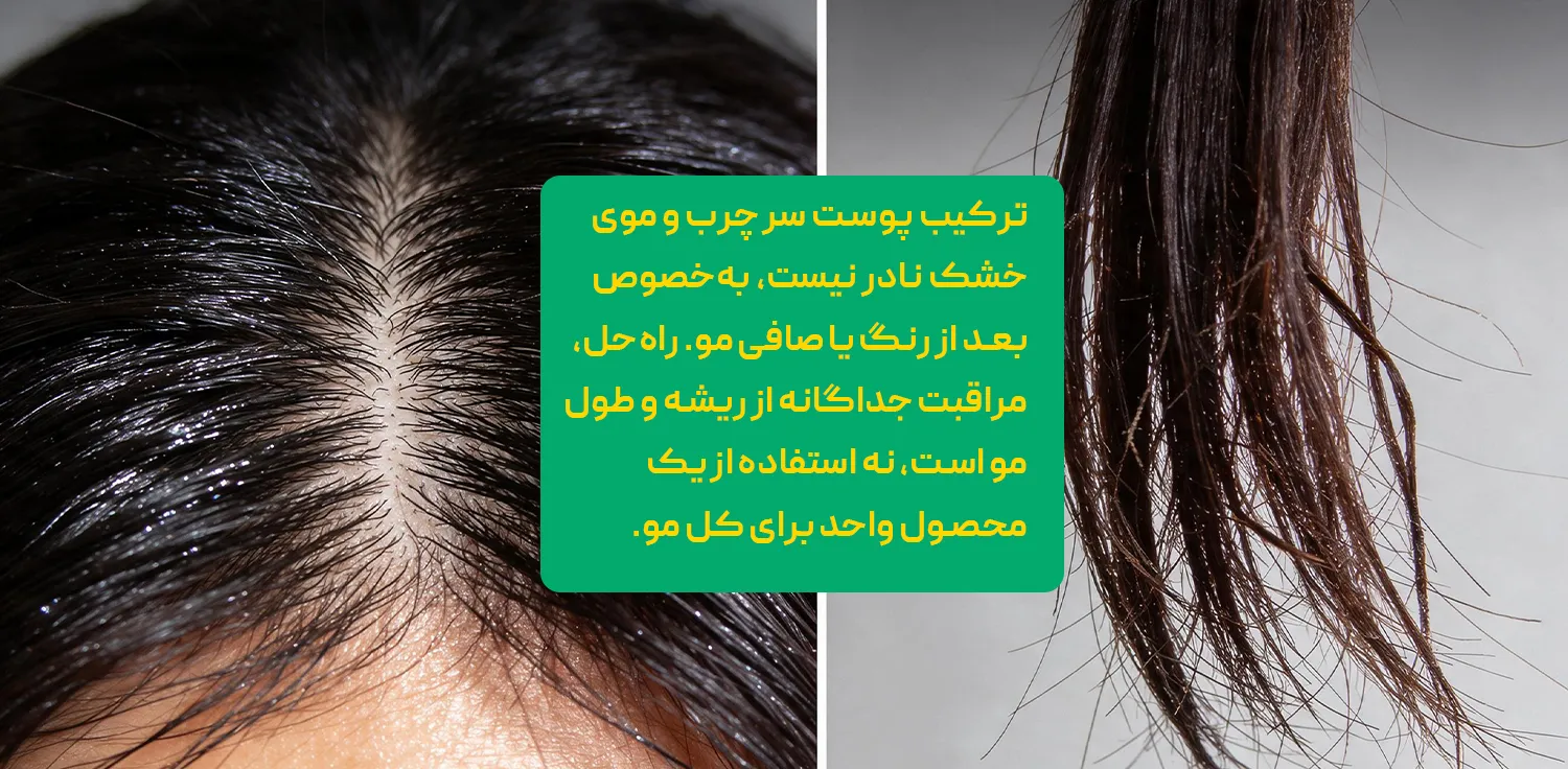 درمان قطعی چربی موی سر درمان قطعی چربی موی سر